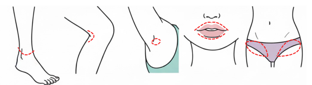 脱毛の照射漏れが起きやすい部位(足首の境目・膝裏のカーブ・ワキの下側・唇の上・Vライン外側)を示したイラスト
