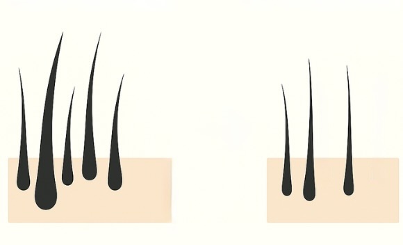 サロン脱毛4年うけた効果。太い毛がさらに減ってまばらになり、細い毛が少し残っている状態のイラスト。