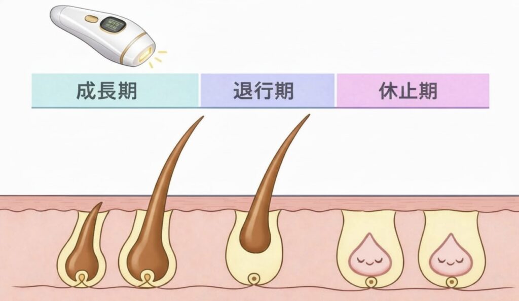 脱毛が長期戦になる理由 濃い色の元気な毛(成長期)は、全体の約20%だけ。 実は、肌の下には「眠っている毛(休止期)」がたくさん控えています。 脱毛機は**「起きている毛」にしか効果がない**ため、眠っている毛が起きてくるのを待ってから、数回に分けて照射する必要があるのです。