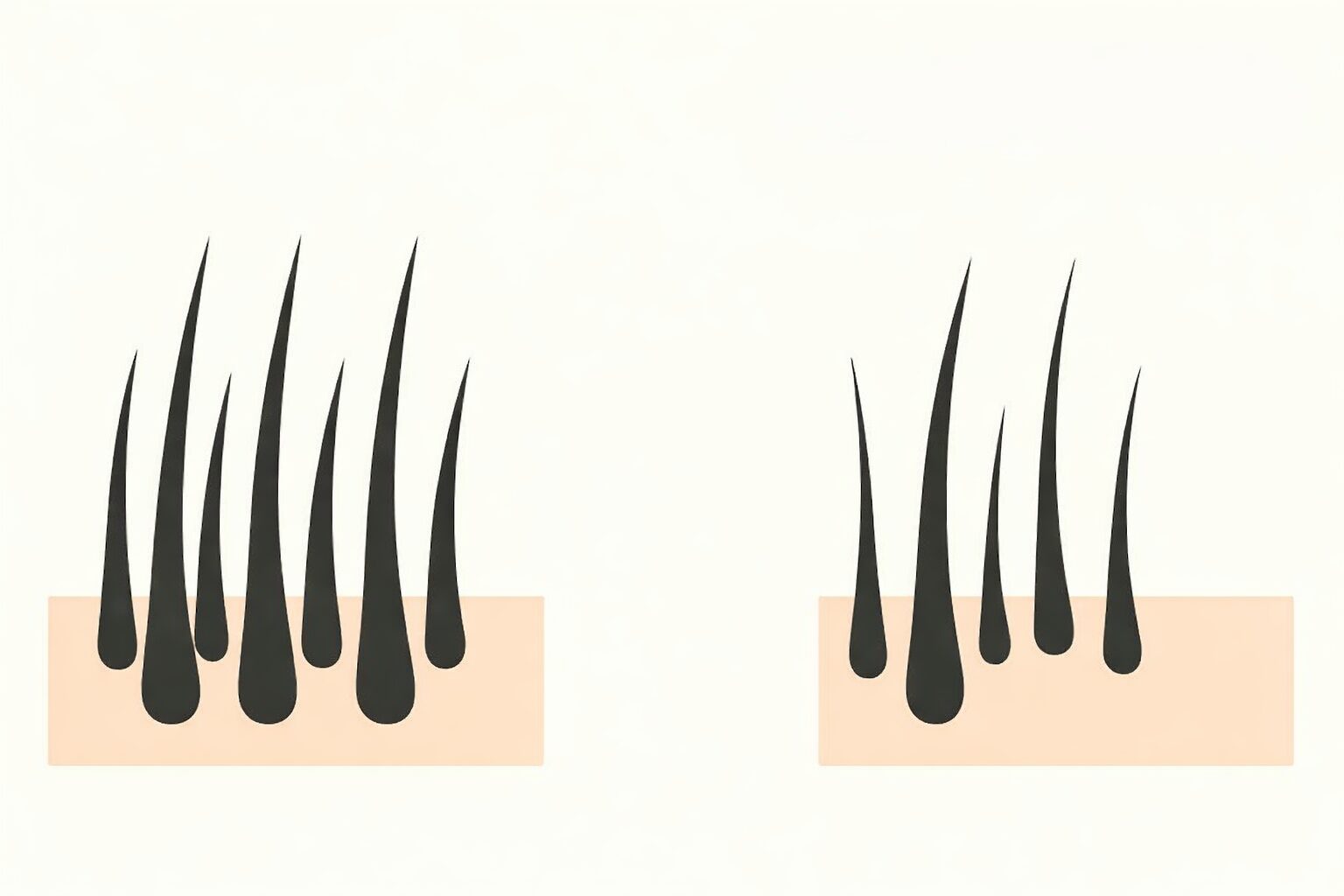 サロン脱毛2年うけた効果。太い毛が減り、一部の毛がポロッと抜け落ちて毛が細くなった様子のイラスト。