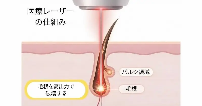 医療レーザー脱毛の仕組み。高出力のレーザーが毛根をピンポイントで狙い撃ちし、熱で破壊する図解。