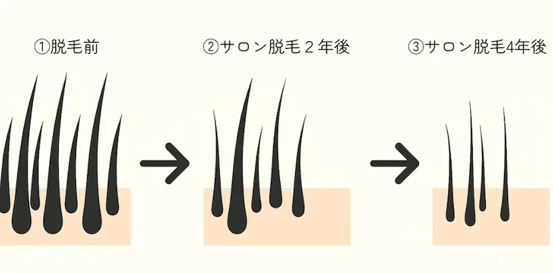 「脱毛前からサロン脱毛2年後・4年後までの毛の変化を図で表したイラスト。太い毛が中細い毛へ、さらに細い毛へと変化し、本数も徐々に減っていく過程を視覚化した図解」