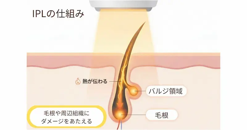 家庭用脱毛器や脱毛サロンで使われるIPL方式の仕組みイラスト。光を拡散させて毛根とバルジ領域へ同時にアプローチする様子。