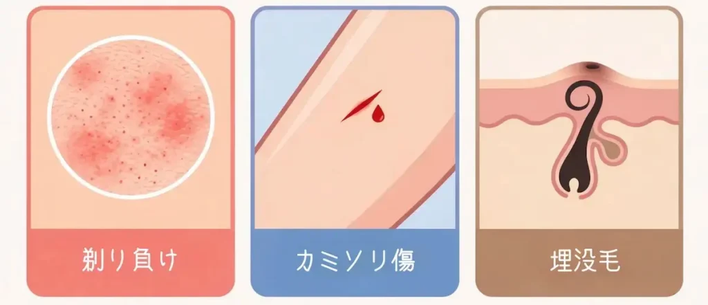 "カミソリ負け・カミソリ傷・埋没毛（まいぼつもう）の3大肌トラブルのイラスト比較"