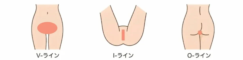 VIO脱毛の範囲(Vライン・Iライン・Oライン)の照射部位を解説したイラスト図解