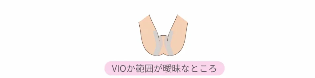 VIOラインは店舗によって照射範囲が異なる。VIOか範囲が曖昧なところをしめしたイラスト。