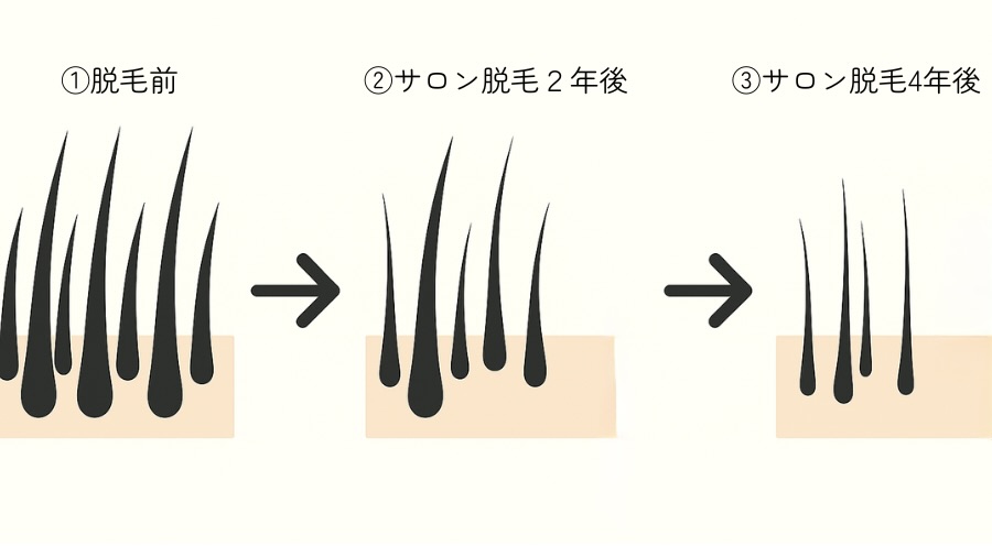 「脱毛前からサロン脱毛2年後・4年後までの毛の変化を図で表したイラスト。太い毛が中細い毛へ、さらに細い毛へと変化し、本数も徐々に減っていく過程を視覚化した図解」